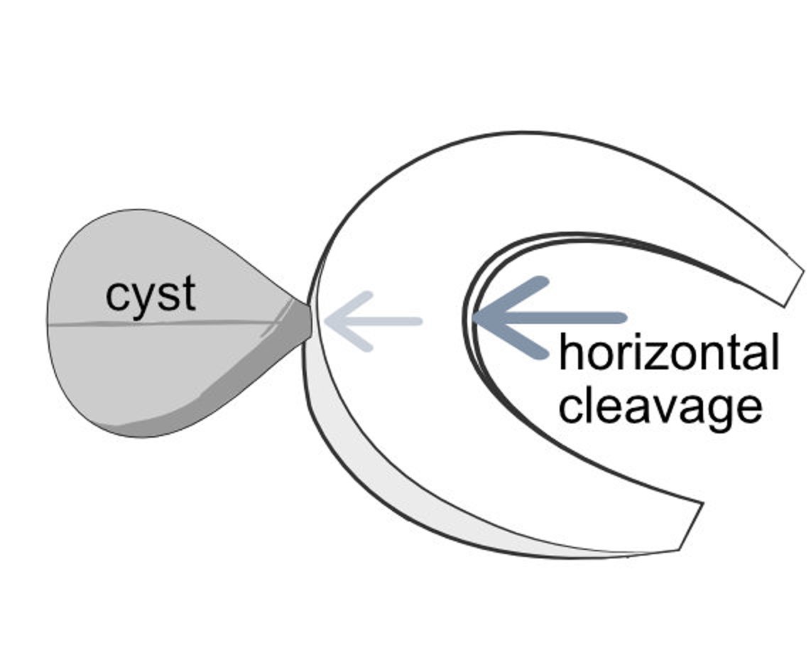 Illustration showing fluid being forced into a horizontal cleavage tear to form a cyst.