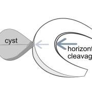 Illustration showing how a horizontal cleavage tear can lead to a meniscal cyst because of a valve-like action.