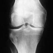 joint line closed on medial side