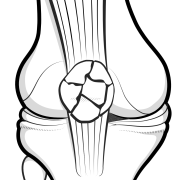 comminuted fracture of the patella