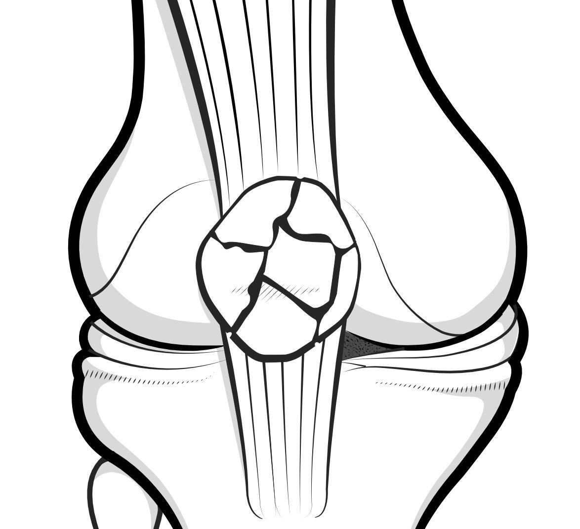 Illustration of a comminuted fracture of the patella.