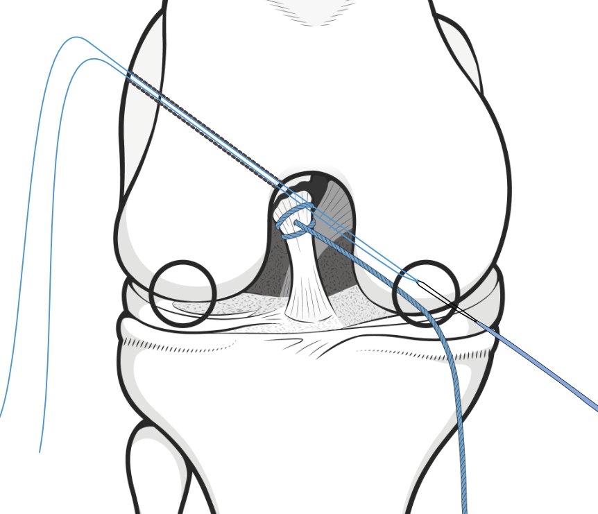 cruciate-repair-procedure.png