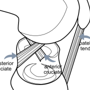 cruciate ligaments - bones distracted