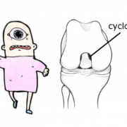 cyclops lesion of the knee