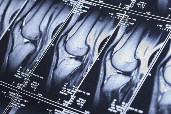 Photograph to show how an MRI image is made of digital slices through the knee,