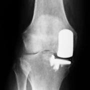 partial knee replacement