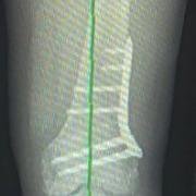 distal femoral osteotomy