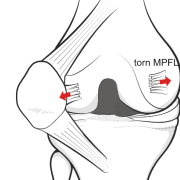 dislocation of the patella with torn MPFL