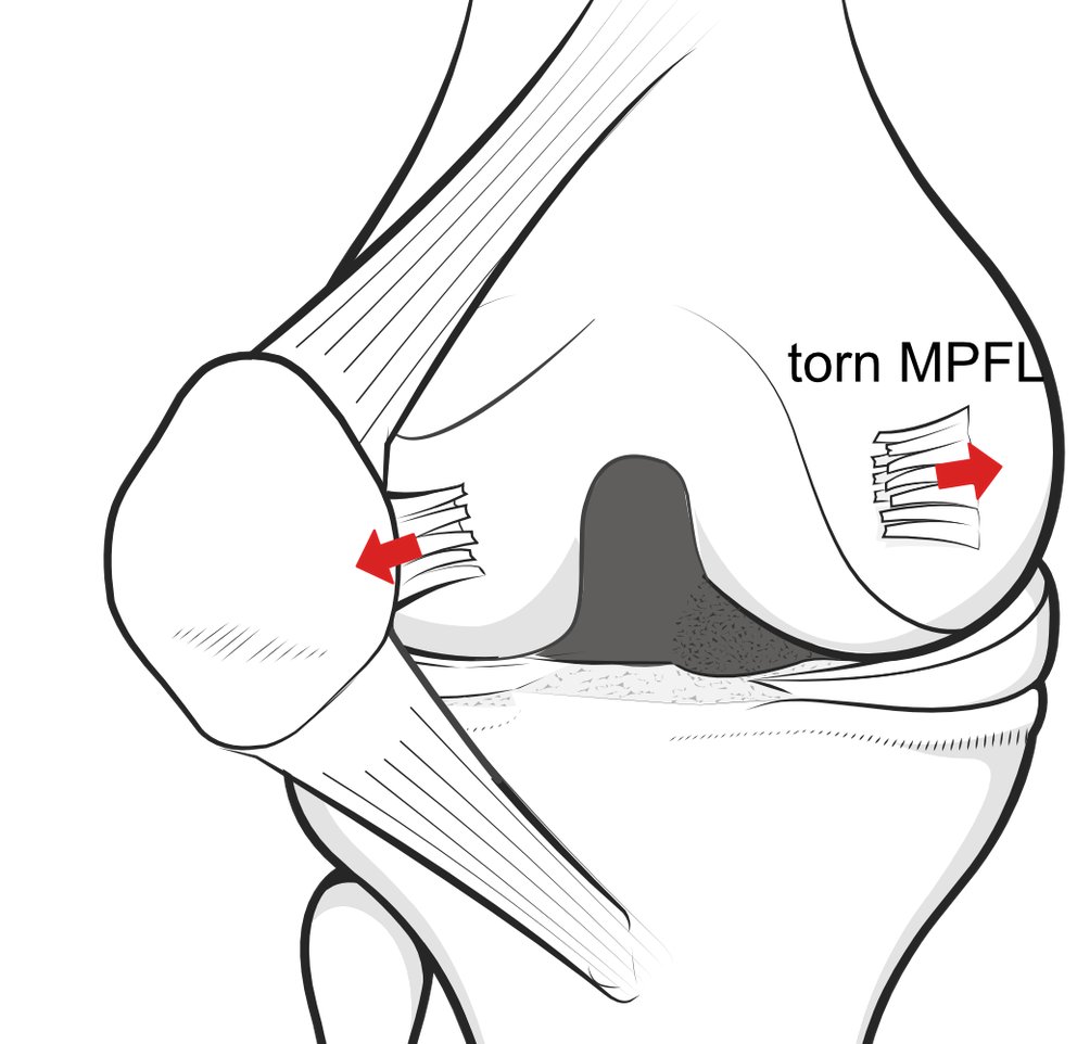 dislocated-patella-05