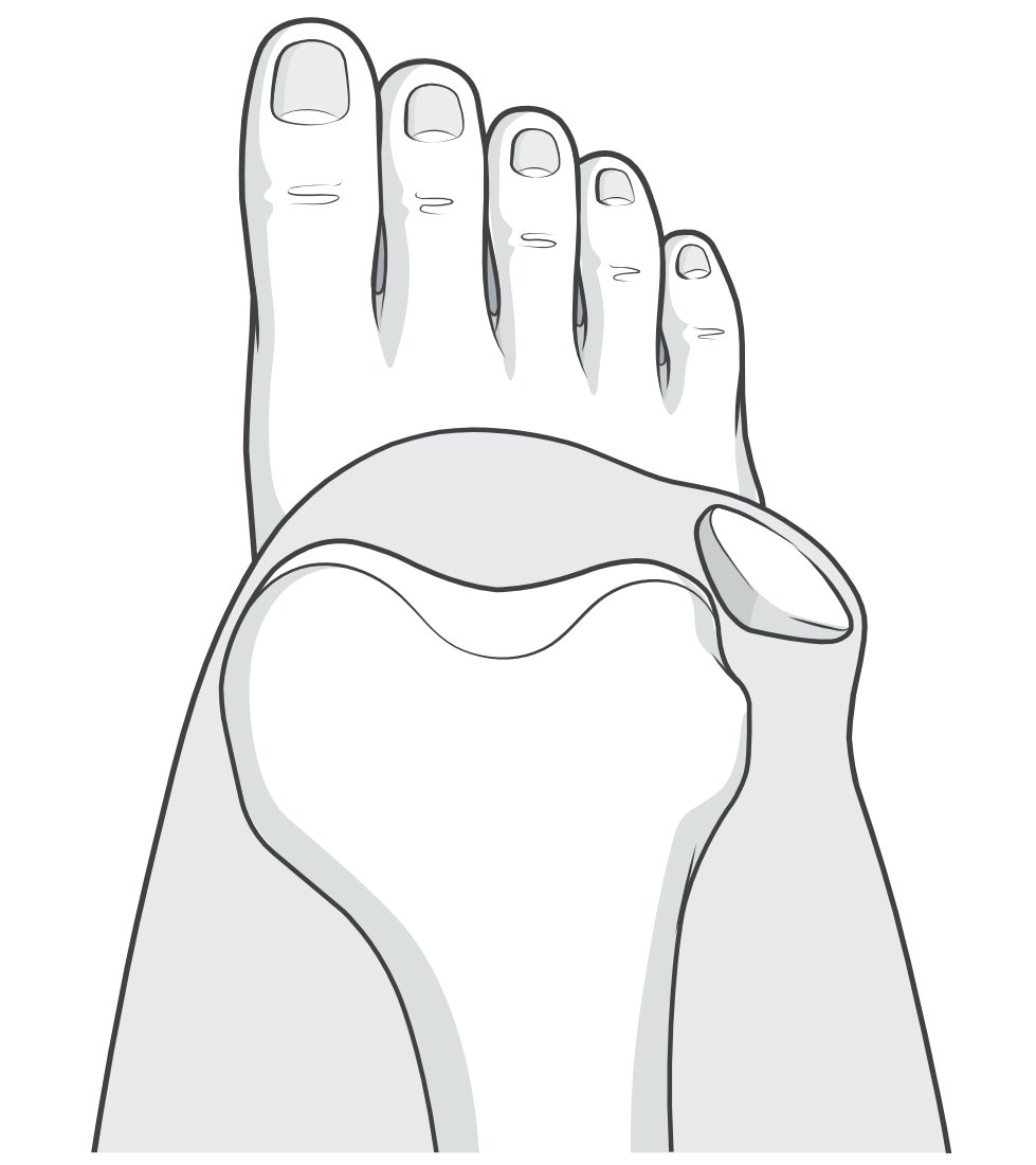 dislocation of patella02