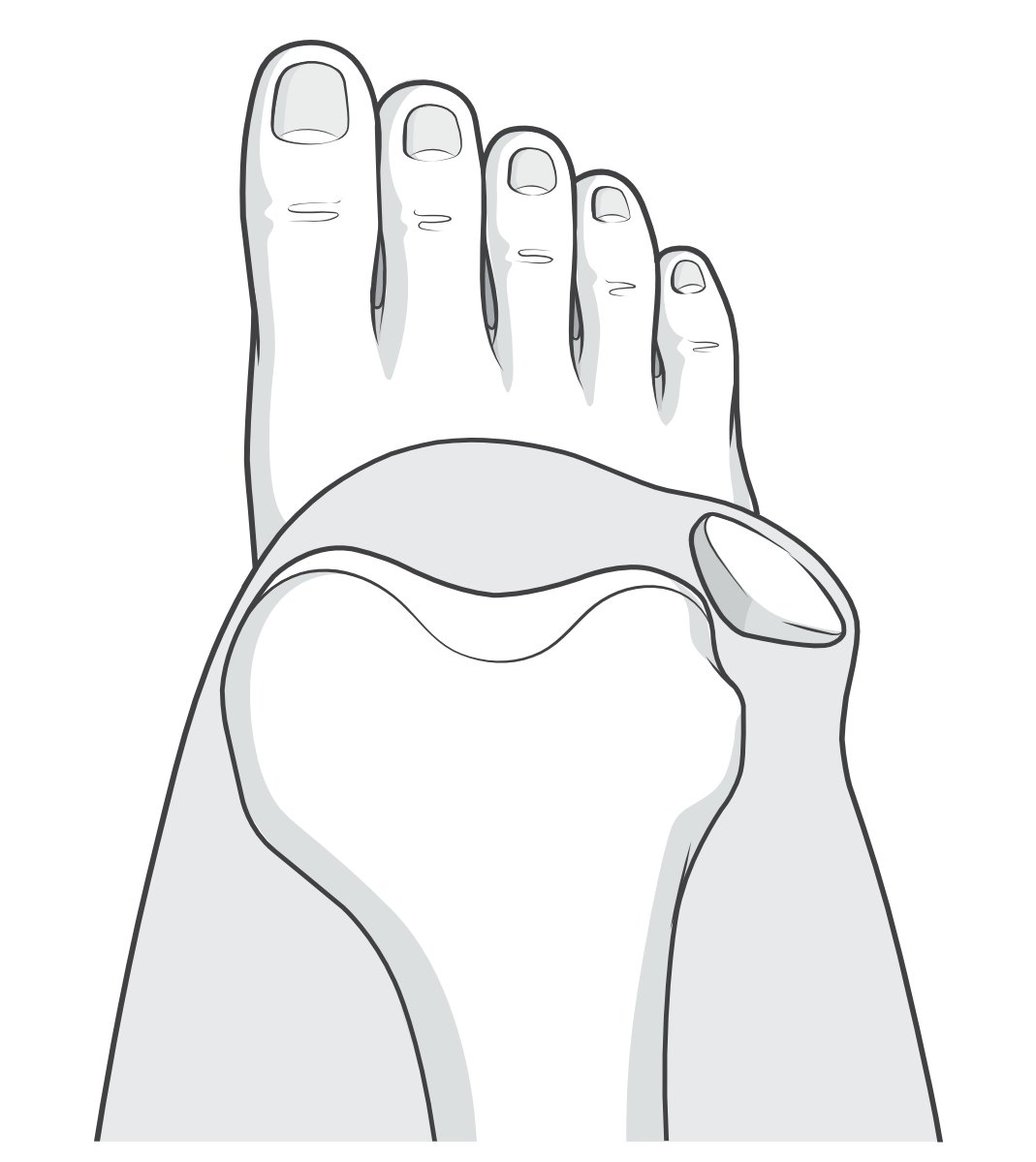 Illustration looking down at the knee to show the position of the patella during a dislocation event.