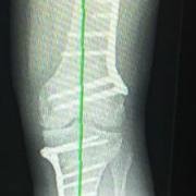 double-level-osteotomy-aw.jpg