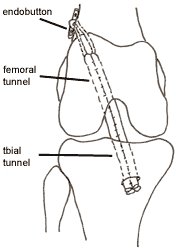 Illustration of positioning and fixation of a new cruciate graft.