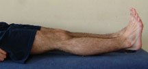 Photograph of patient lying on their back with the legs fully extended.