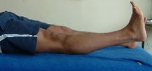 Photograph of patient lying with leg extended. In this instance the heel lifts up off the plinth.
