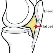 Iluustration of the knee joint from the side, to show the sensitive fat pad area.