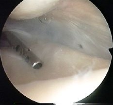 arthroscopy fluid inlet
