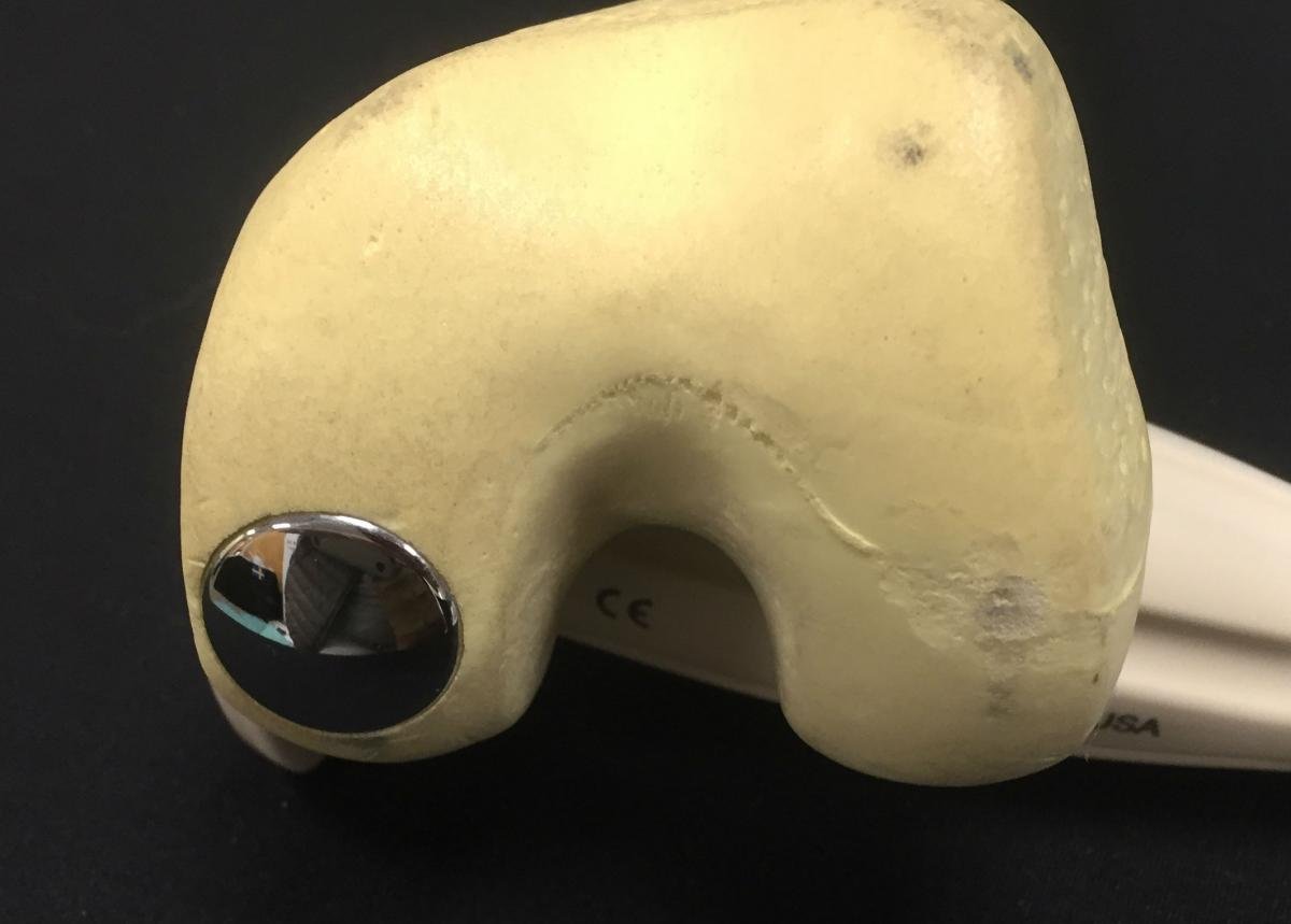 focal femoral implant