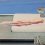 autograft construct of hamstrings tendons