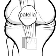 fulkerson osteotomy