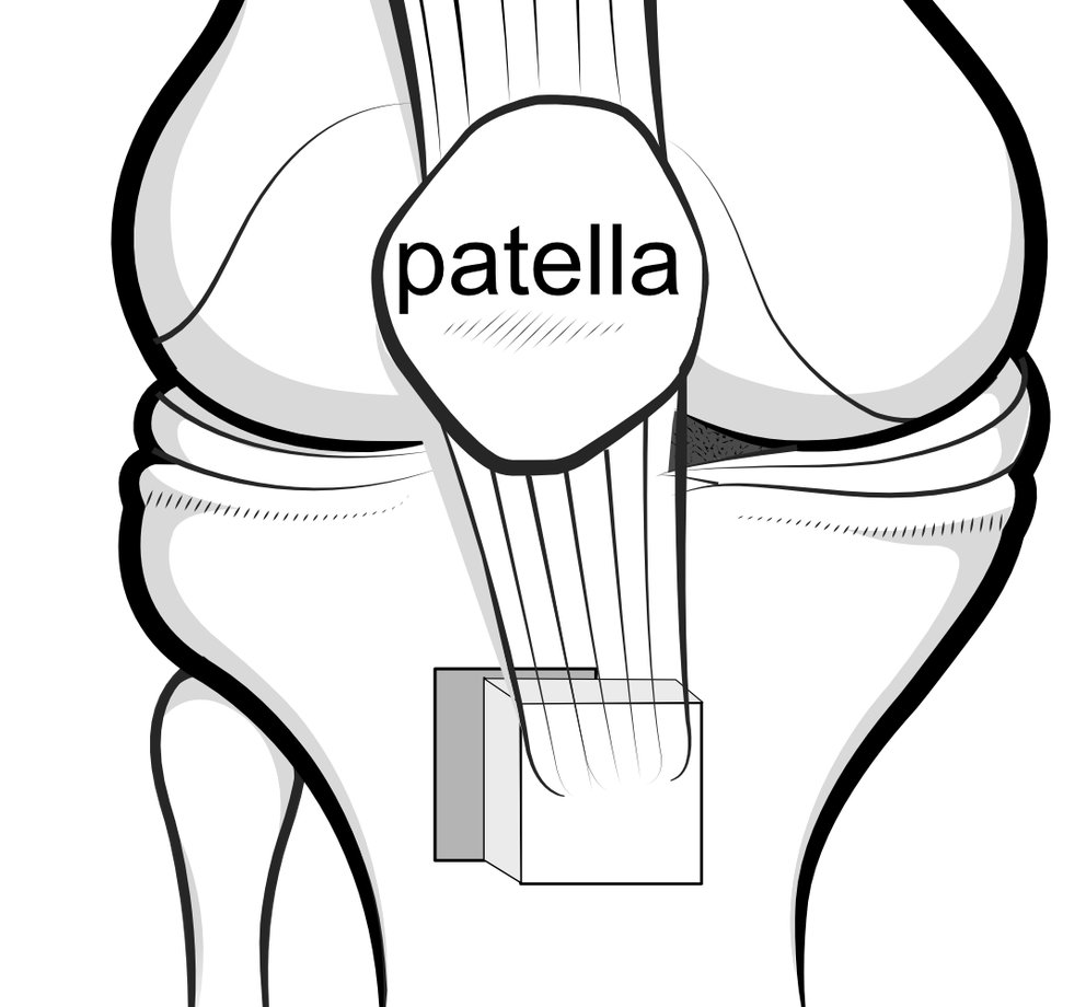 Illustration of a Fulkerson osteotomy, with the lower patella and underlying bone block being moved to a better position.