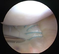 sutured meniscal tear