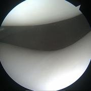 grade-0-cartilage-damage_0.jpg