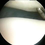 Photograph during arthroscopy to demonstrate dimpling of softened articular cartilage when pressed by a probe.