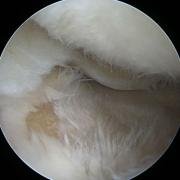 grade-4-cartilage-damage_02_0.jpg