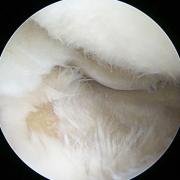 Photograph taken during arthroscopy to demonstrate fibrillation of articular cartilage.