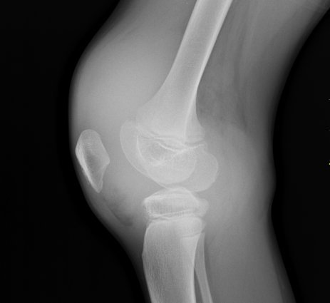 haemarthrosis.jpg