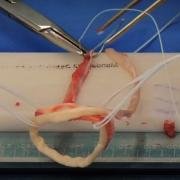 hamstrings graft being quadrupled