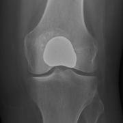X-ray of the knee joint, showing a patellofemoral implant.