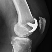 X-ray of the knee joint from the side, showing a patellofemoral arthroplasty.