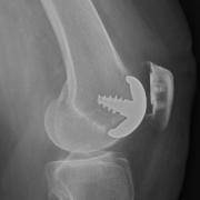 X-ray of the knee joint from the side showing a patellofemoral knee replacement.