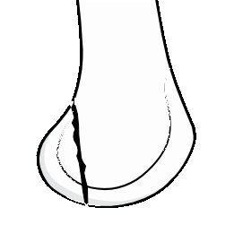 hoffa-fracture.png