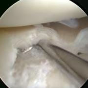 Photograph during keyhole surgery, showing the surgeon probing a horizontal cleave tear of the meniscus.