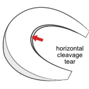 horizontal cleavage tear of the meniscus