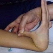 hypermobility-copyright-vaishya.jpg