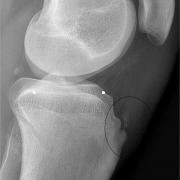 Osgood Schlatters ossicle