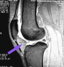 fat pad of knee