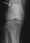 images_patella_00003.jpg