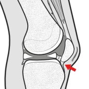 infrapatellar-contracture.png