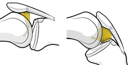 IPP-fat pad complex