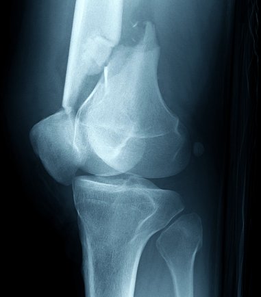 fractured lower femur