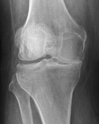 joint-gap-narrowing-lb.jpg
