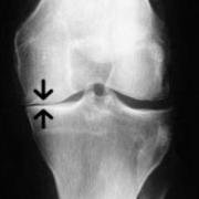 knee joint space narrowing