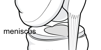 Illustration showing the position of the two menisci sandwiched between the lower end of the femur and the upper end of the tibia.