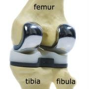 Components of a total knee replacement demonstrated on model bones.