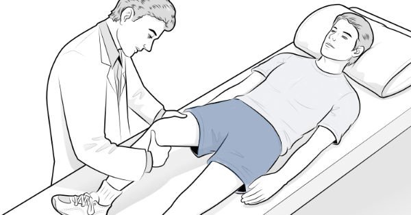 Illustration of surgeon performing the Lachman test on a patient lying on a bed